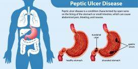 消化性溃疡疾病信息图