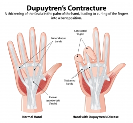 人体手掌手指骨折医学解剖图