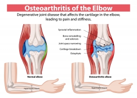 卡通骨关节炎肘医学素材