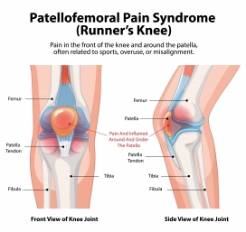 手绘卡通髌股关节疼痛综合征图解