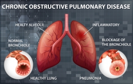 慢性阻塞性肺病医学素材