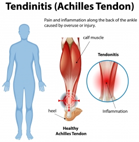 跟腱炎医学插图