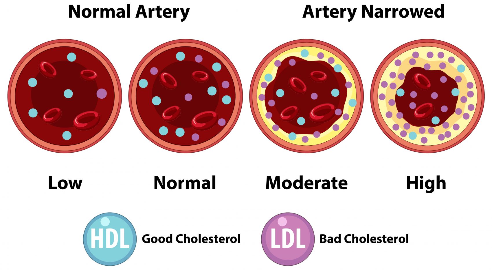 卡通胆固醇水平动脉图示图片